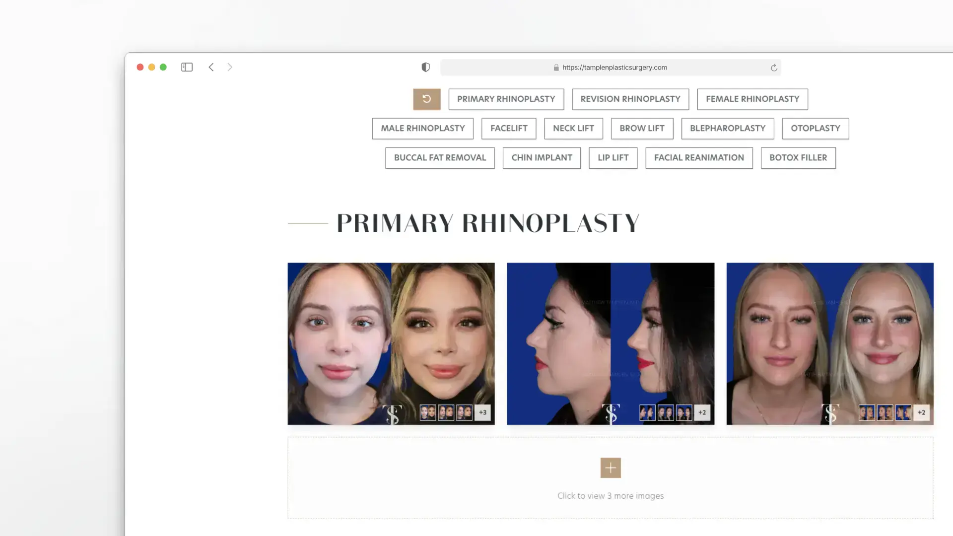 Tamplen Plastic Surgery - Desktop Before and After Gallery and Filters